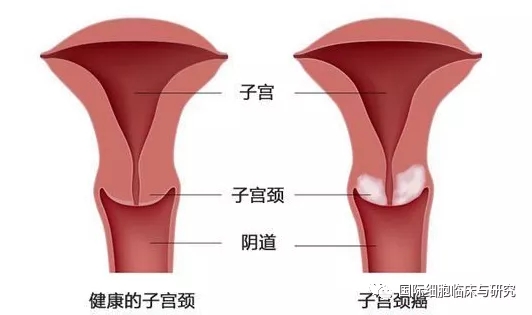 宫颈癌新药,抗体偶联药Tisotumab Vedotin疗效强劲